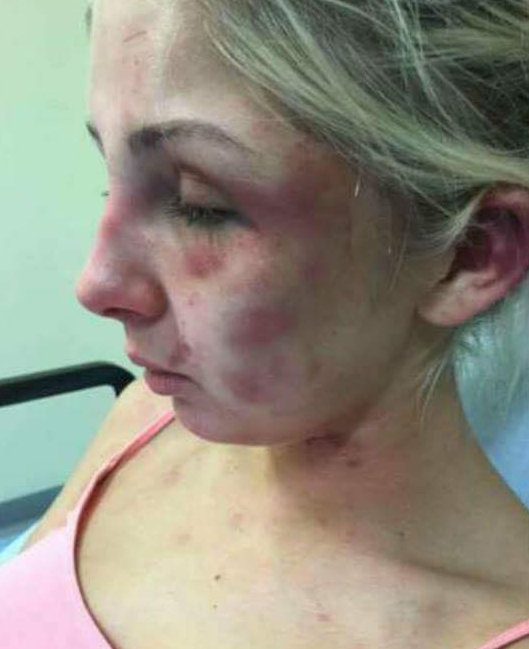 A DOMESTIC abuse victim has revealed sickening pictures of the horrific injuries she suffered at the hands of her former partner.Brave Kelsie Skillen was beaten to a pulp by her vicious boyfriend James McCourt, 19, at the home they shared together.The graphic pictures show her injuries after being subjected to a beating lasting four hours in June this year.Kelsie, 19, a make up artist from Bishopbriggs, near Glasgow, was rushed to hospital following the attack which left her with cuts to her face and covered in bruises.McCourt has been remanded in custody to await sentencing after he admitted the brutal assault during an appearance at Glasgow Sheriff Court.Kelsie said she wanted to warn other people about McCourt so that they don't suffer the same fate as her.