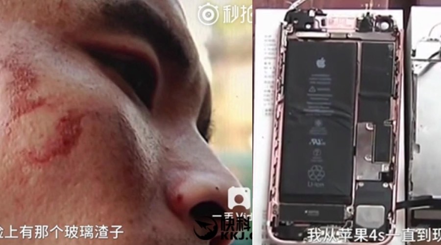 Mans face after bitten iphone battery explodes in it