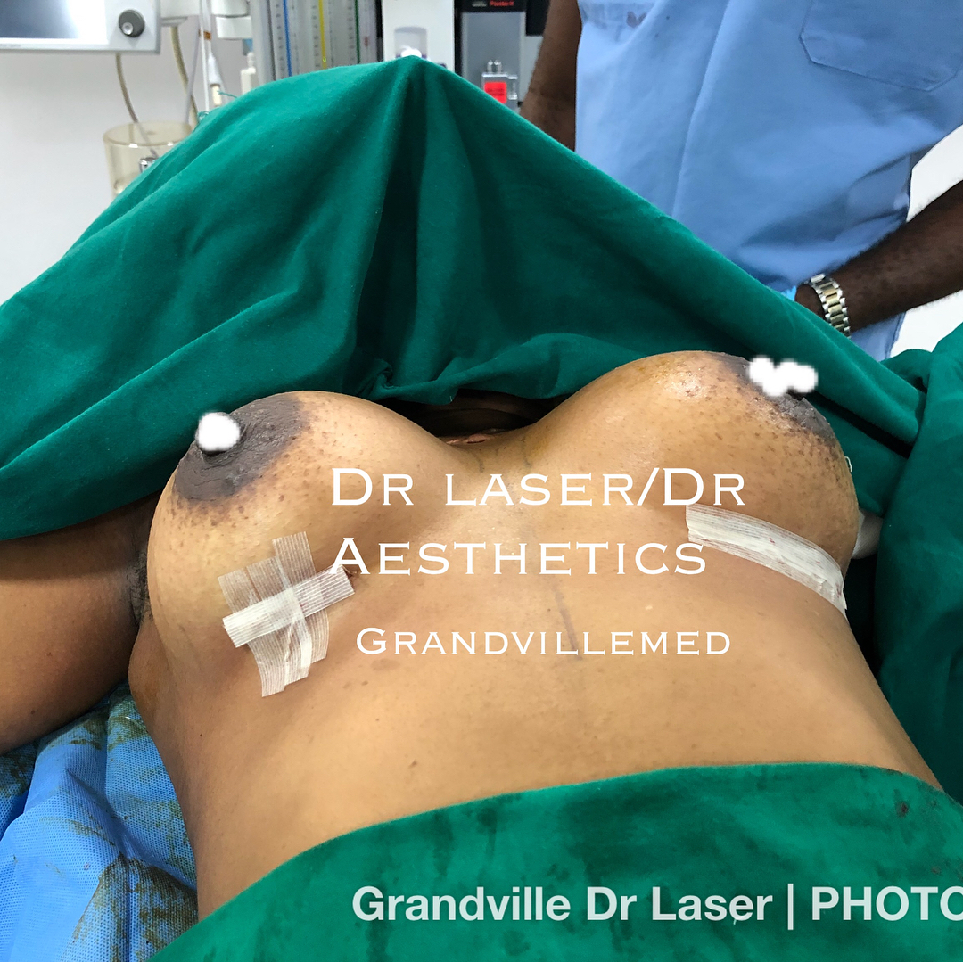 Grandville med laser Procedures