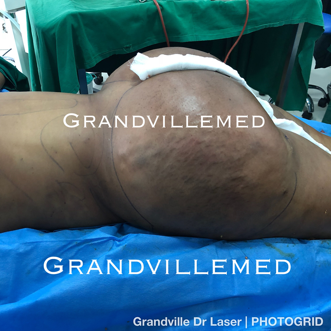 Grandville med laser Procedures