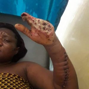 Election Violence: woman hacked by strangers survives first surgery (photos)  