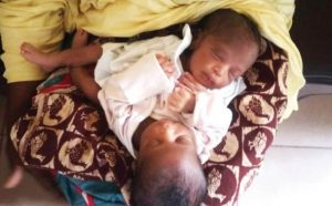 Residents storm Bauchi hospital after lady gives birth to conjoined twins 