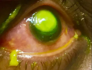 Graphic Photos: Contact lenses severely damage woman’s eyes