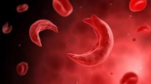 Over 80 members lost to Sickle cell