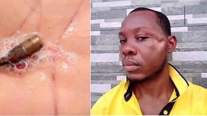 See Pictures of Man Who Vomited Stray Bullet