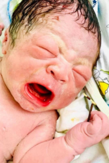 Newborn makes triumphant entry into the world with Mother's contraceptive coil in his hand