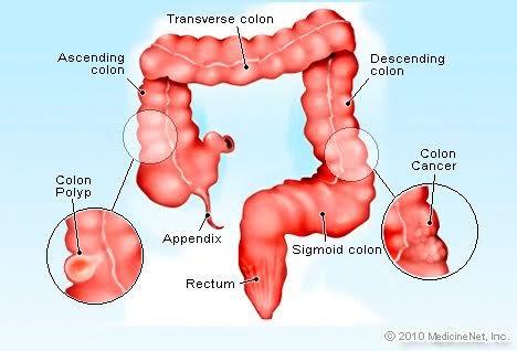 Symptoms of colon cancer
